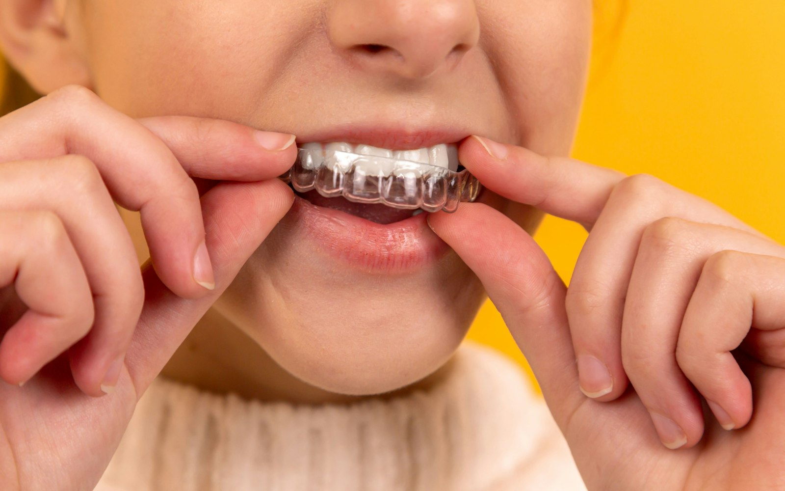 Persona colocándose un alineador dental transparente