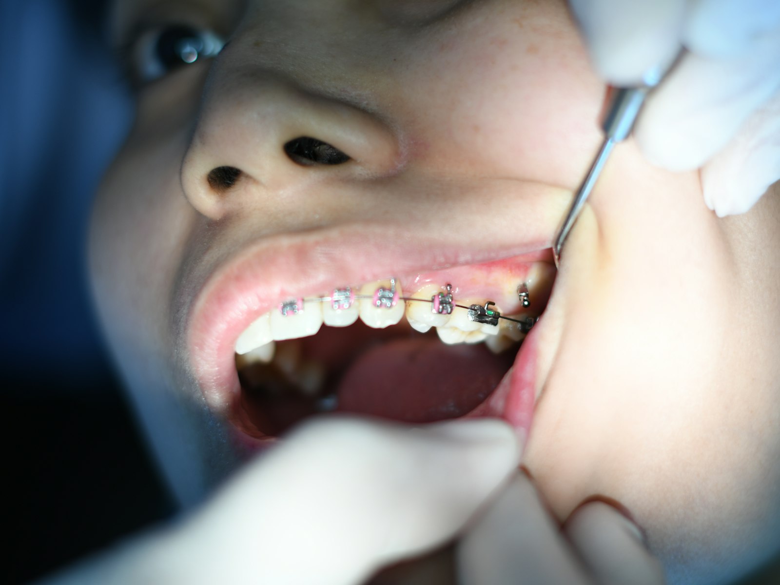 Sonrisa con brackets metálicos