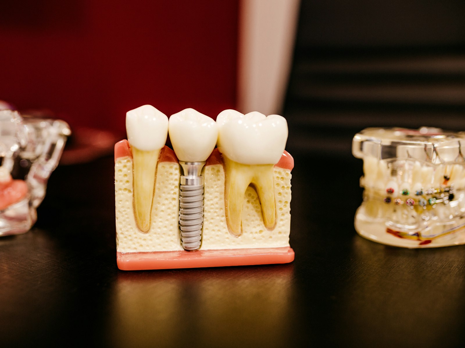 Modelo de implante dental con su corona